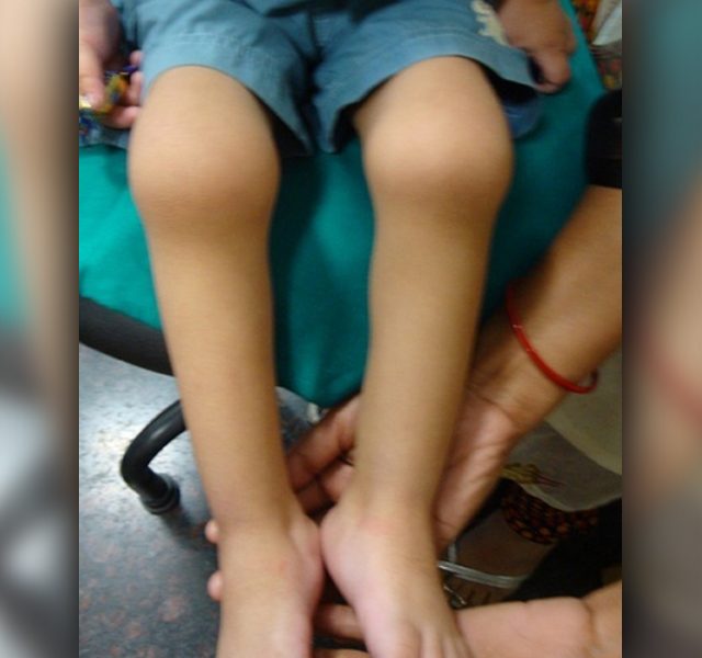 Oligoarthritis affecting the knees and ankles in a four year old boy