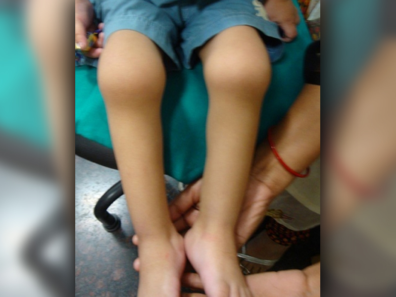 http://childrheumatologist.com/wp-content/uploads/2017/03/Oligoarthritis-affecting-the-knees-and-ankles-in-a-four-year-old-boy.jpg