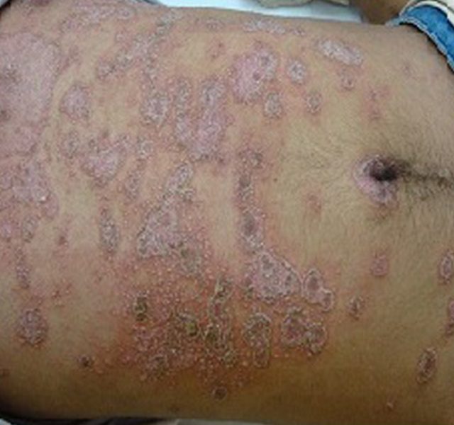 Psoriasis on the Trunk in a teenage boy