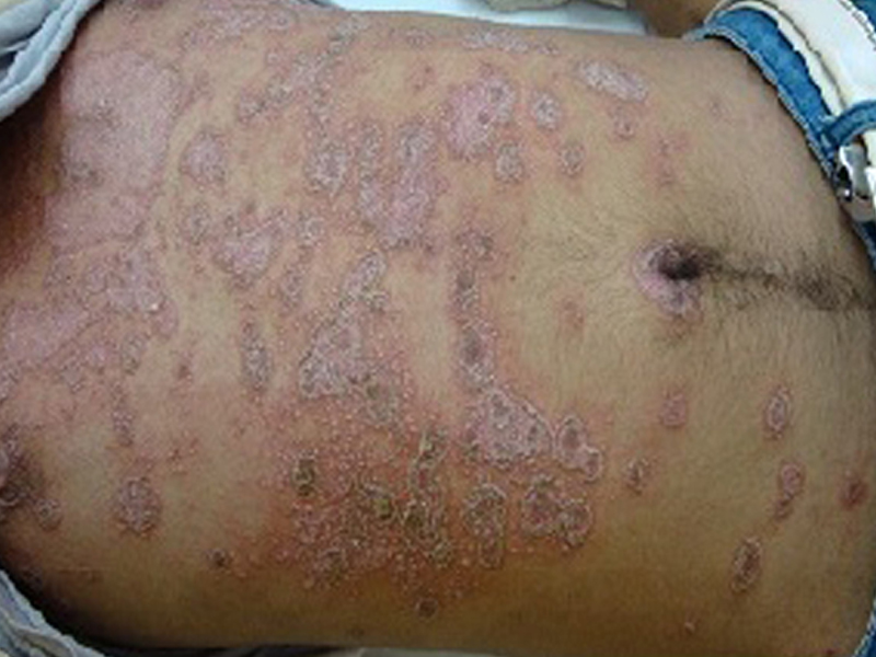 http://childrheumatologist.com/wp-content/uploads/2017/03/Psoriasis-on-the-trunk-in-a-teenage-boy.jpg