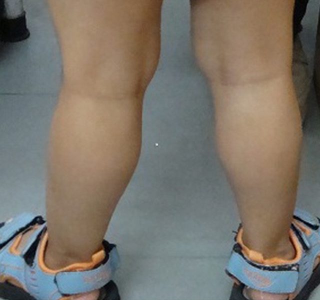 Calf Hypertrophy in a child with Duchenne Muscular Dystrophy