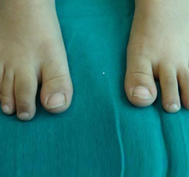 Dactylitis of the right second toe: Psoriatic Arthritis