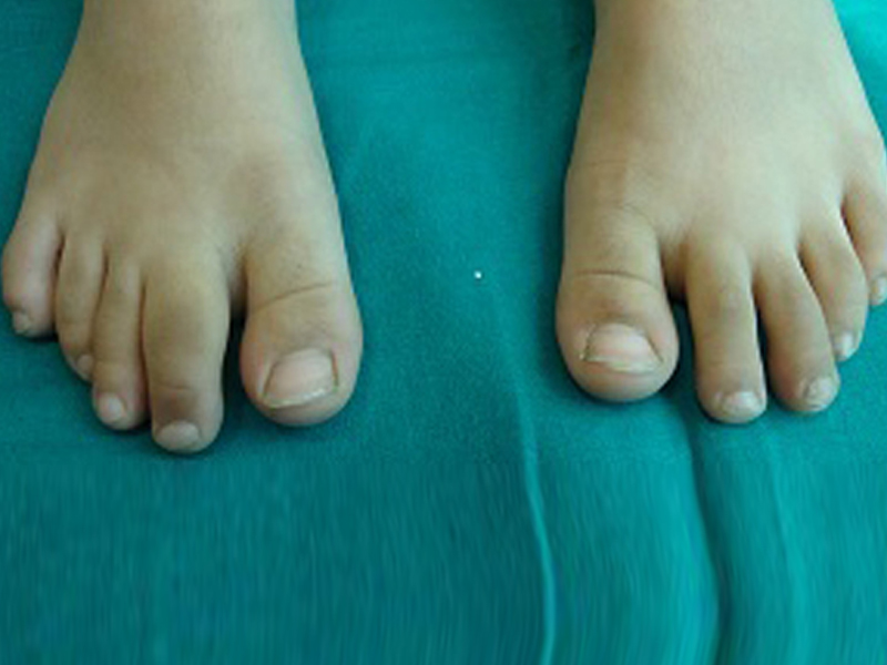 http://childrheumatologist.com/wp-content/uploads/2017/03/dactylitis-of-the-right-second-toe.jpg