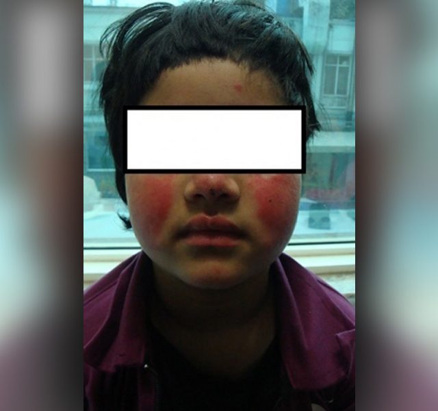 Malar Rash in young girl with Lupus