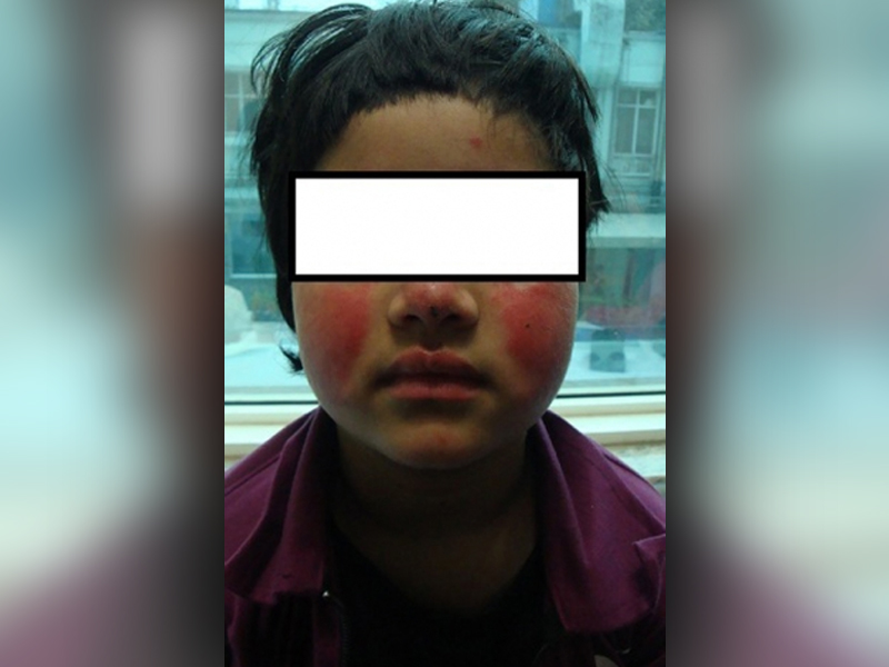 http://childrheumatologist.com/wp-content/uploads/2017/03/malar-rash-in-young-girl-with-lupus.jpg