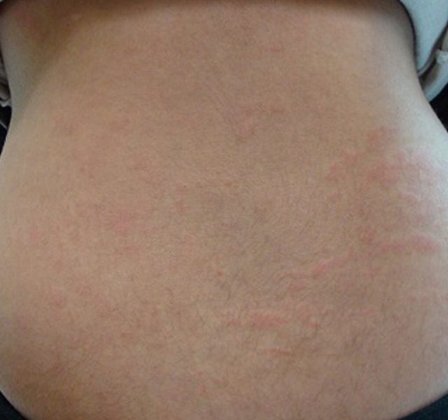 Rash in a child with systemic onset Juvenile arthritis