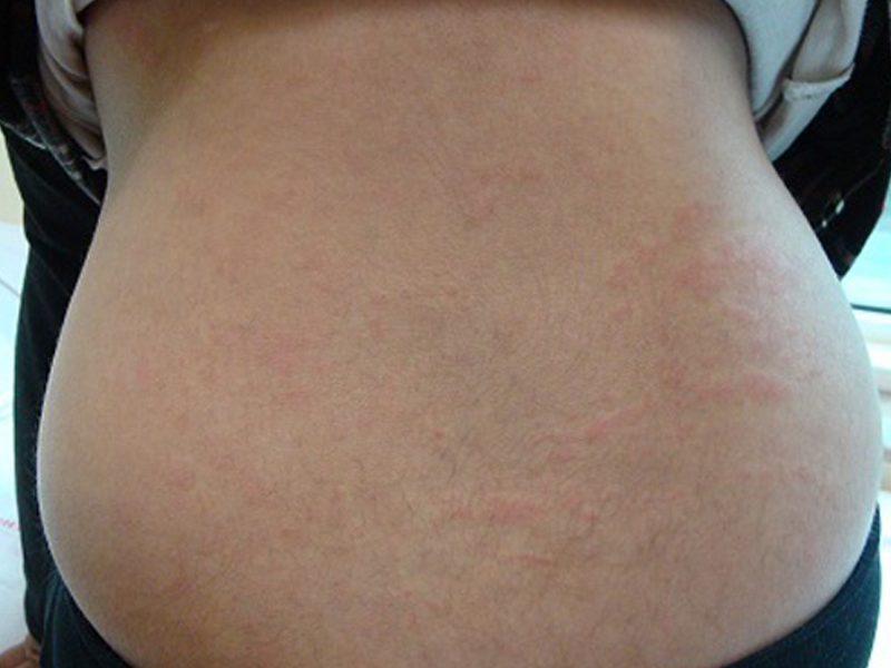 http://childrheumatologist.com/wp-content/uploads/2017/03/rash-in-a-child-with-systemic-onset-juvenile-arthritis.jpg